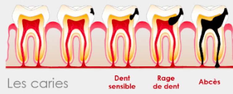 développement carie