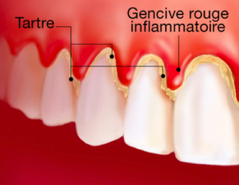 schéma gingivite